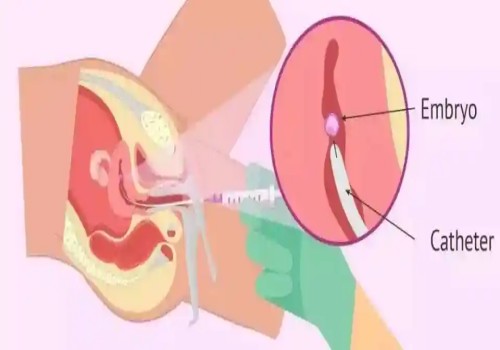 偶發還是遺傳？看看4號染色體三體異?，F象的真正原因
